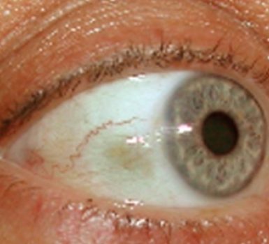 Golpeteo del párpado