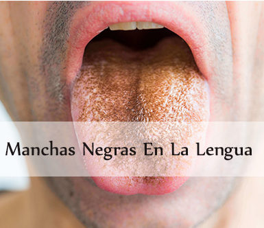 Manchas negras en la lengua